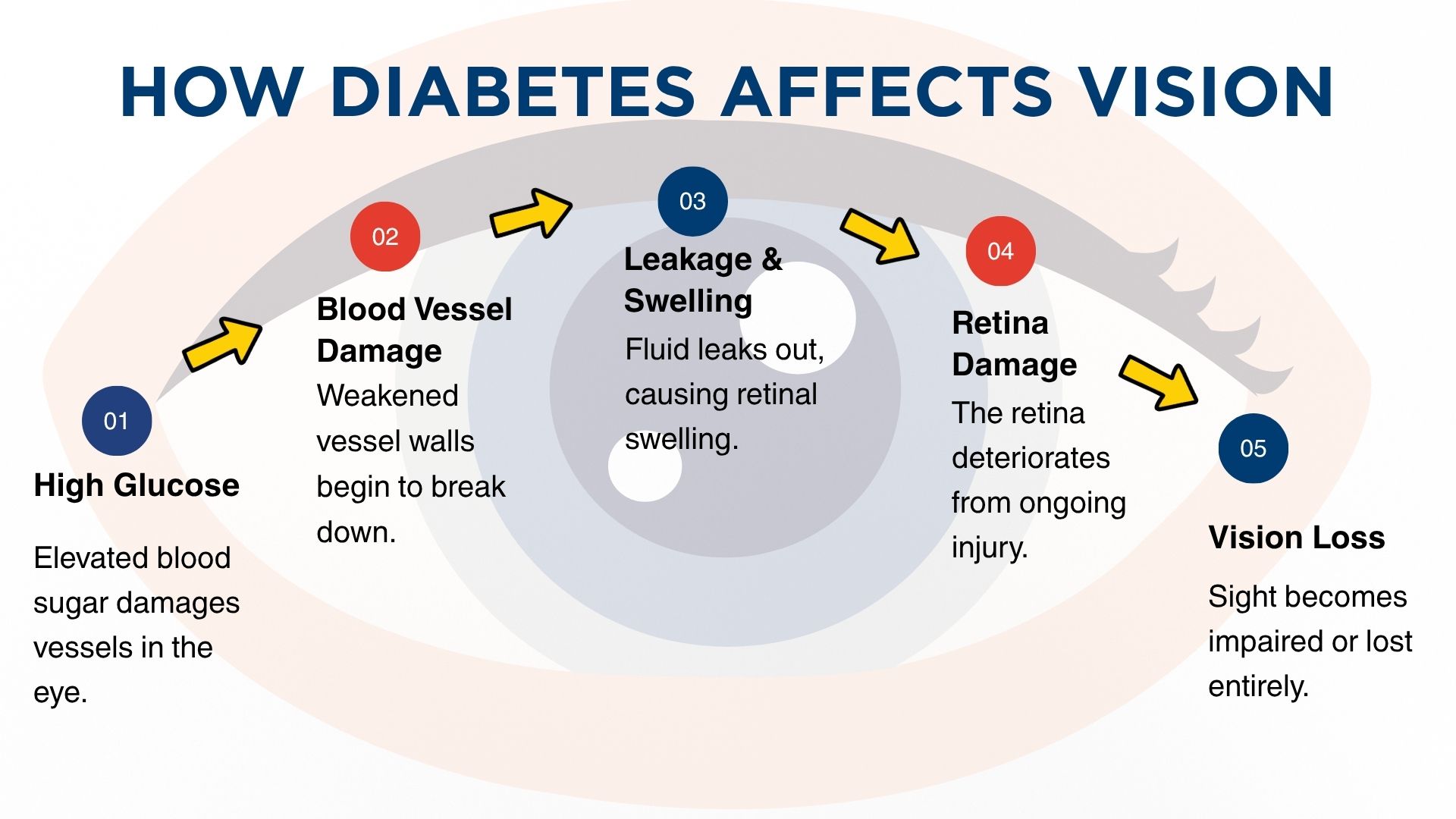 Infographic on how diabetes affects vision, showing stages from high glucose to vision loss with arrows and numbers (01–05).